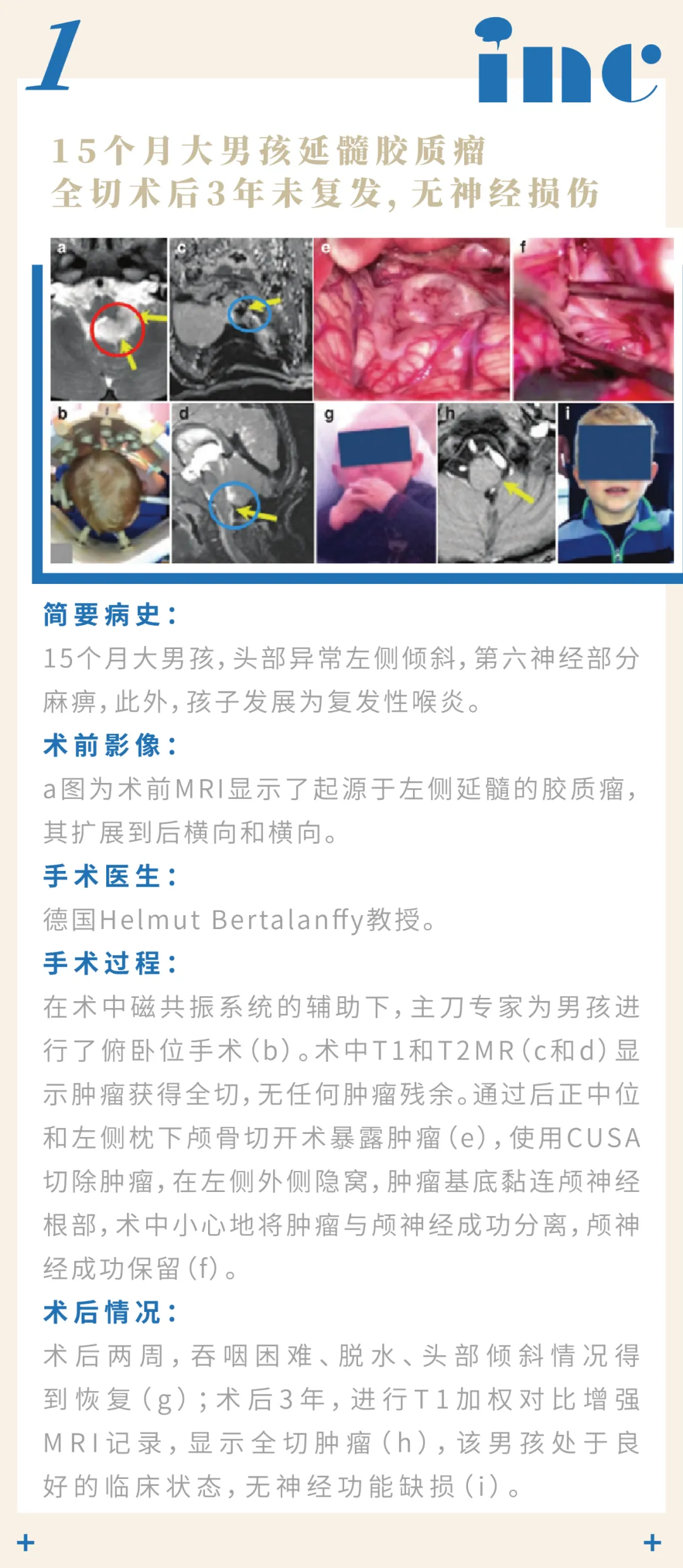 巴特朗菲教授脑干-延髓胶质瘤章节交流案例图片