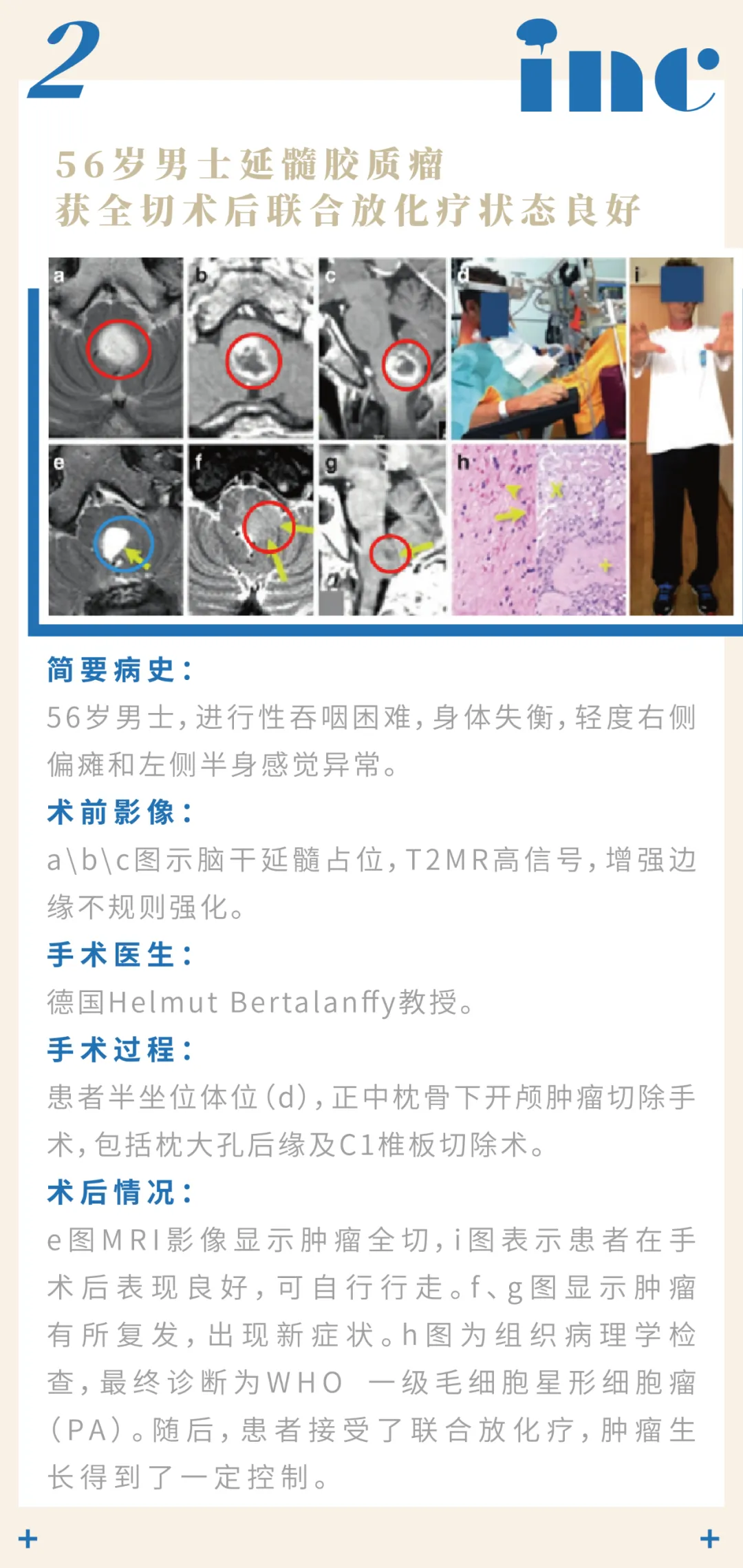 巴特朗菲教授脑干-延髓胶质瘤章节分享案例2图片