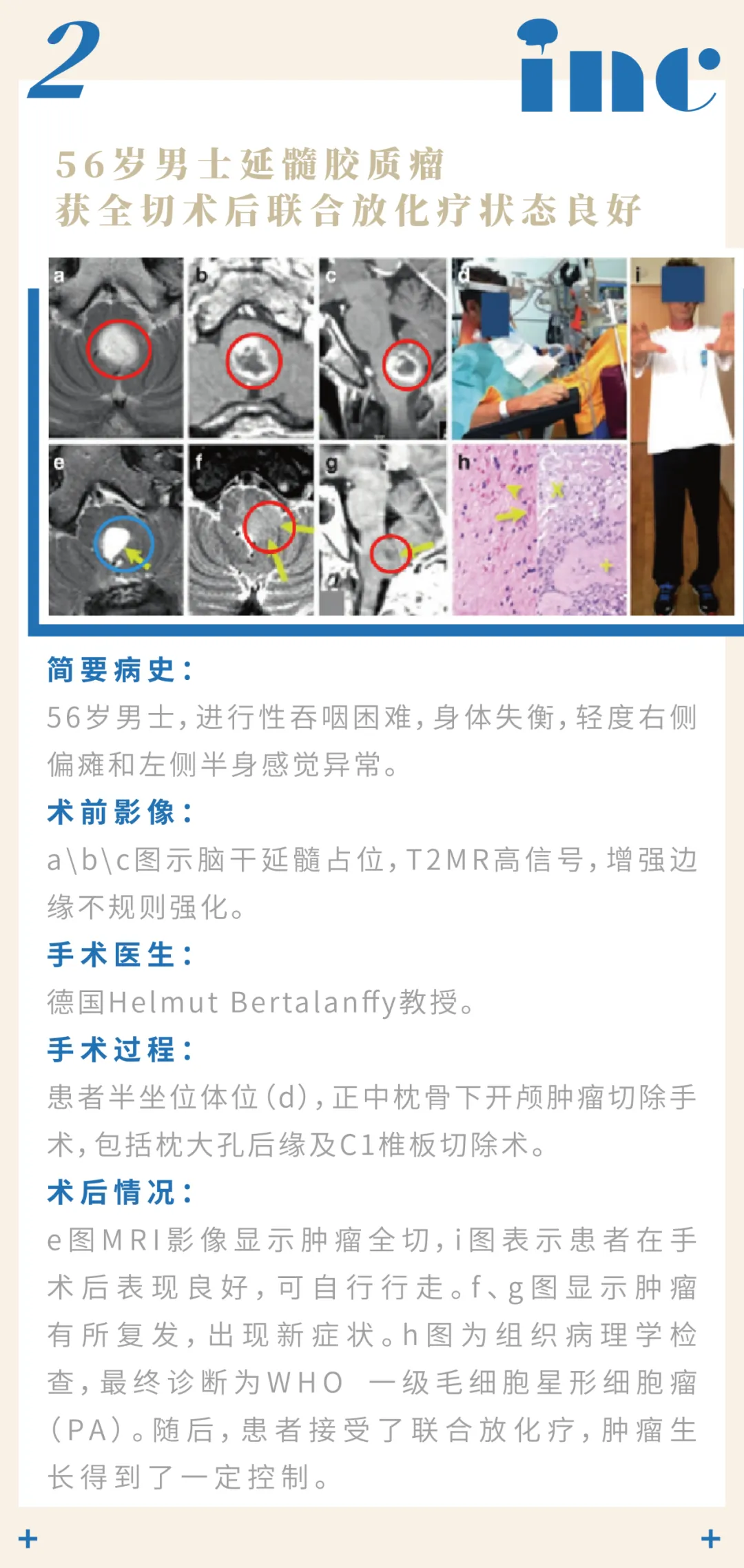 巴特朗菲教授脑干-延髓胶质瘤章节交流案例2图片
