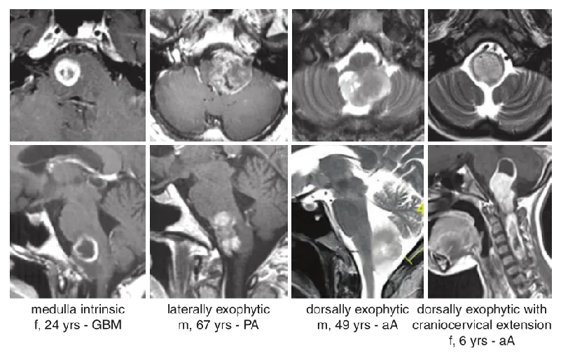 MRI显示不同性质的延髓肿瘤的经典生长位置，其中，aA为间变性星形细胞瘤，GBM为胶质母细胞瘤，PA为淋巴细胞性星形细胞瘤。