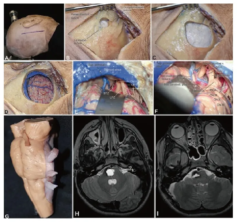 脑干延髓胶质瘤手术入路图片——乙状窦后入路