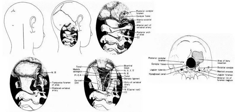Bertalanffy和其导师Seeger（1991）提出的“dorsolateral,suboccipital,transcondylar approach”入路图片