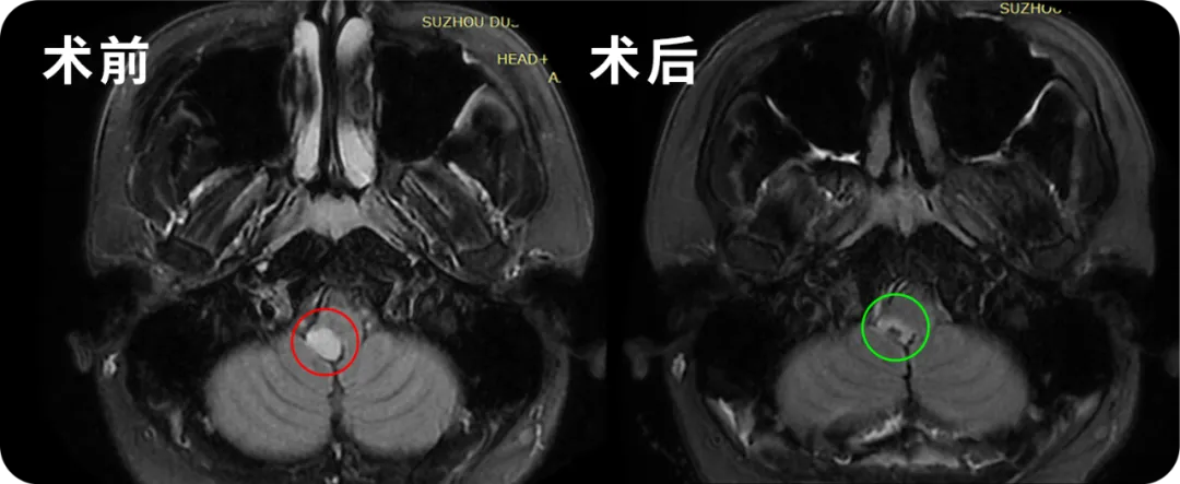 脑干延髓胶质瘤影像图片
