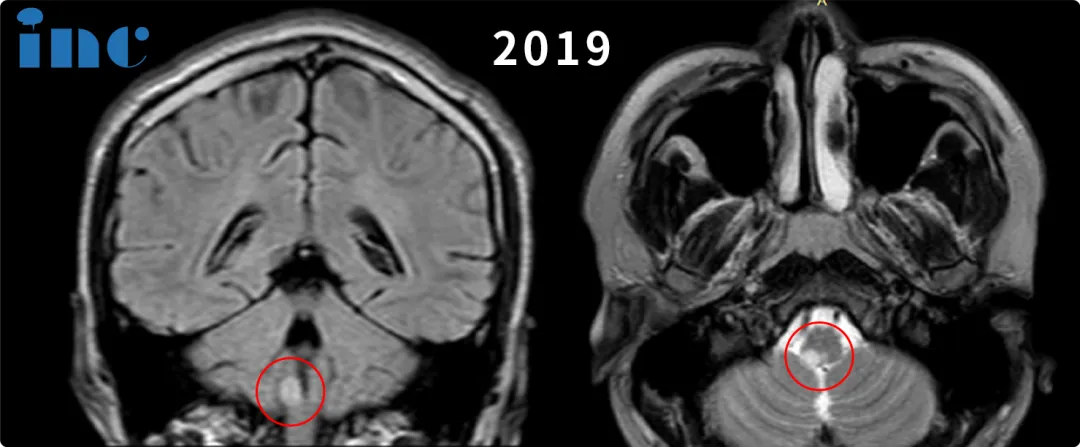 脑干延髓胶质瘤影像图片