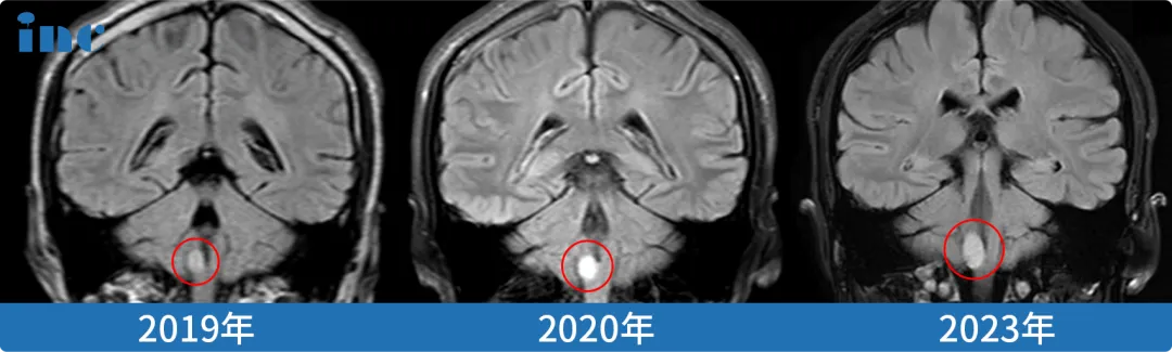 脑干延髓胶质瘤真实案例影像图片