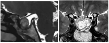 巨大垂体瘤耐药又术后复发——术后MRI图片