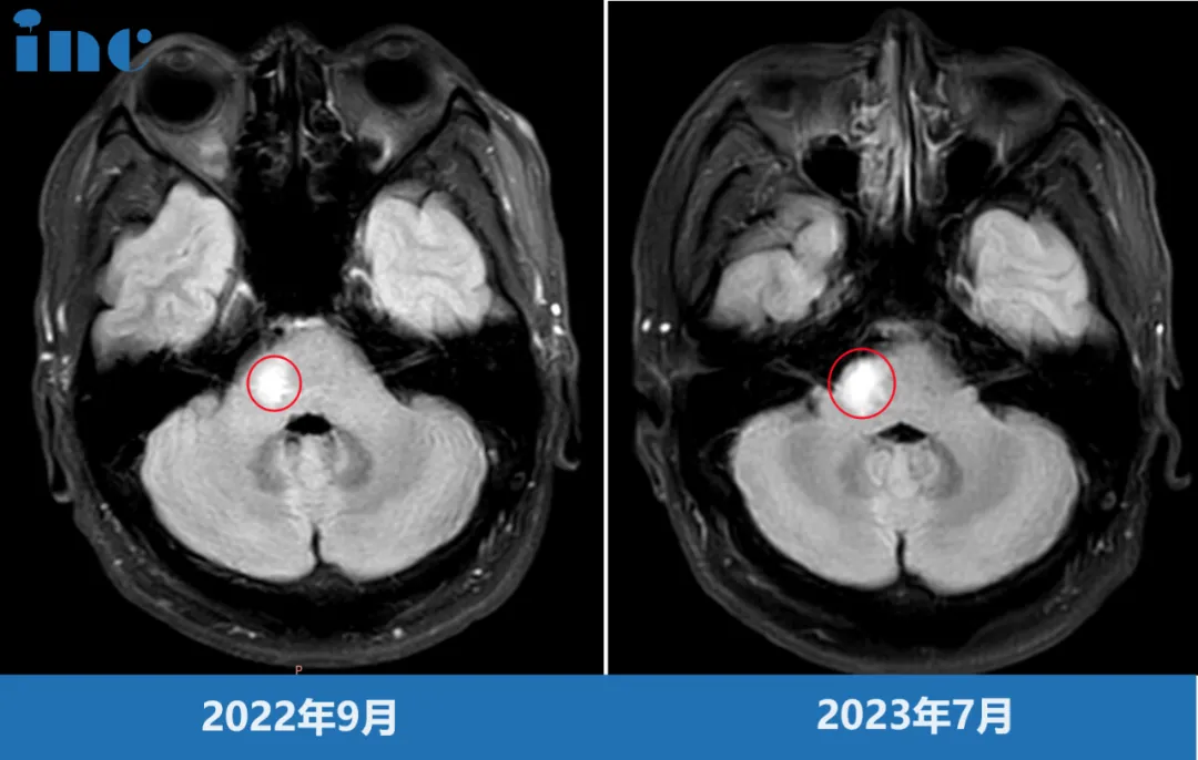脑干-桥臂胶质瘤影像图片