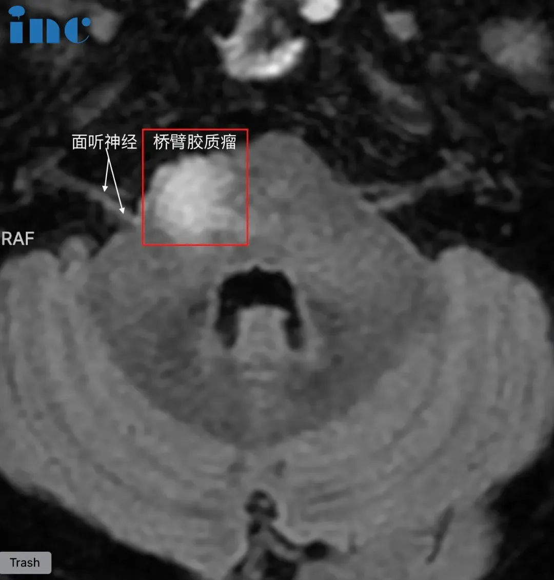 脑干-桥臂胶质瘤图片