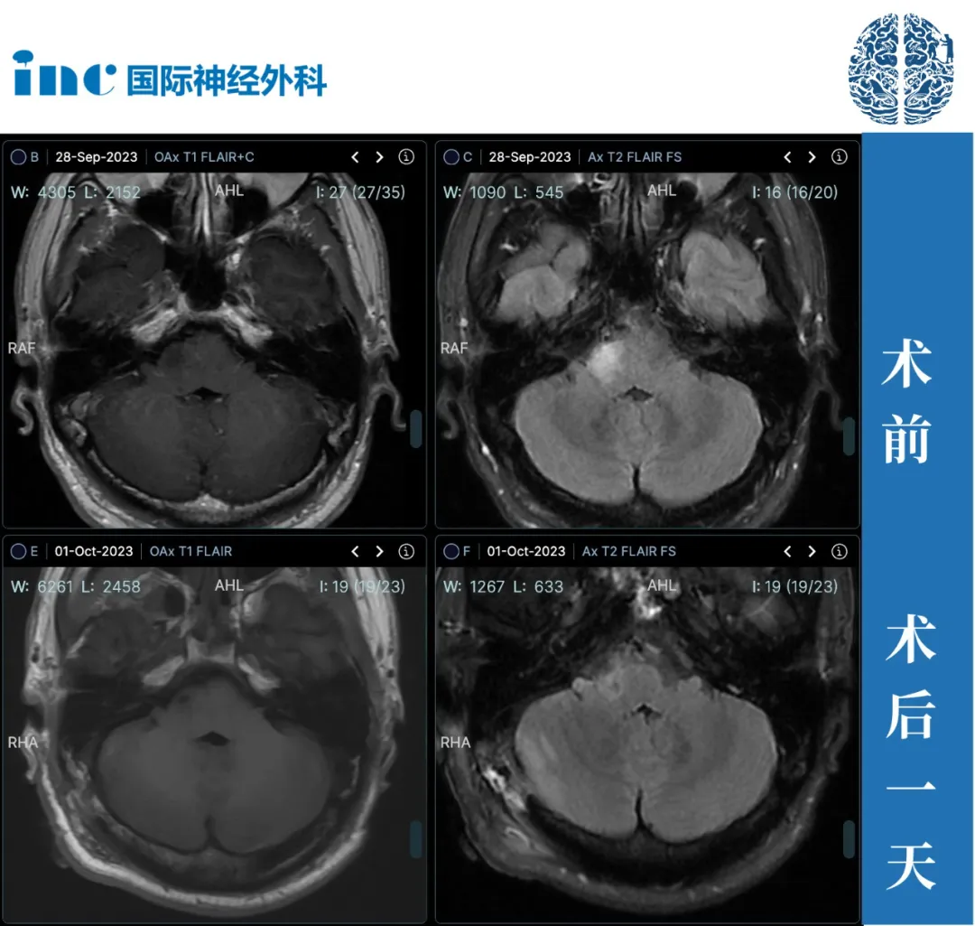 脑干-桥臂胶质瘤真实案例图片