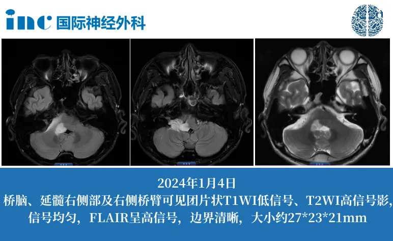 胶质瘤治疗案例