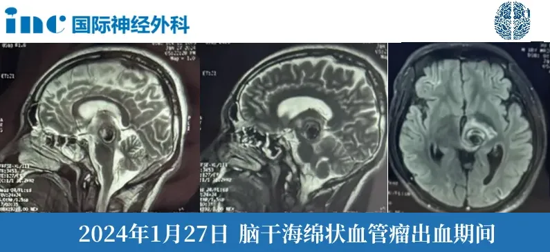 2024年巴教授3月疑难脑瘤示范手术