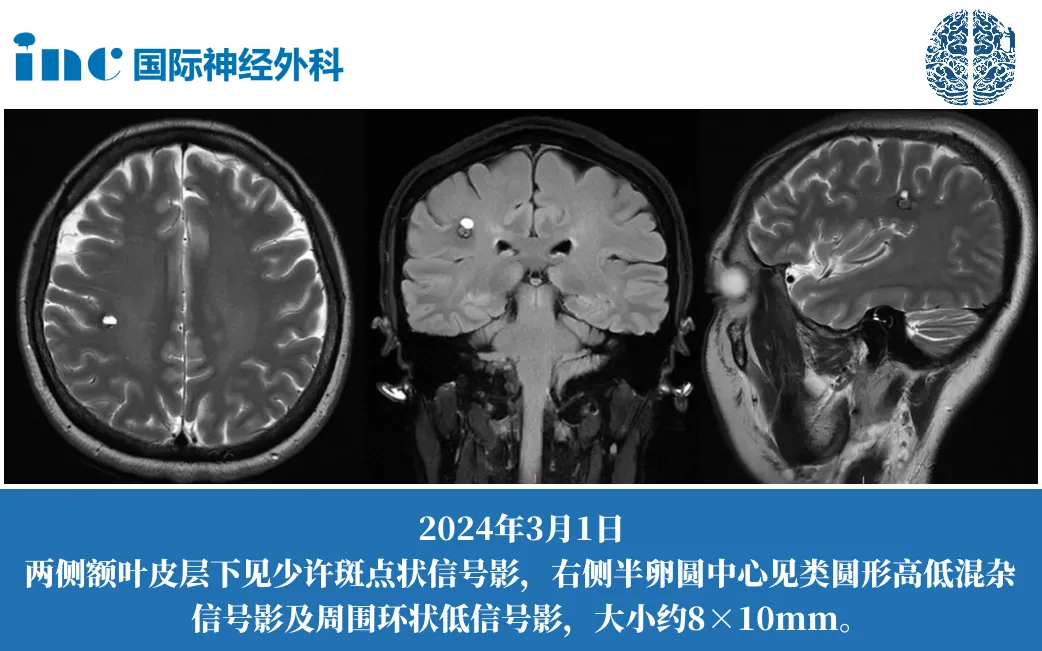 47岁女性-右侧半卵圆中心海绵状血管瘤——影像