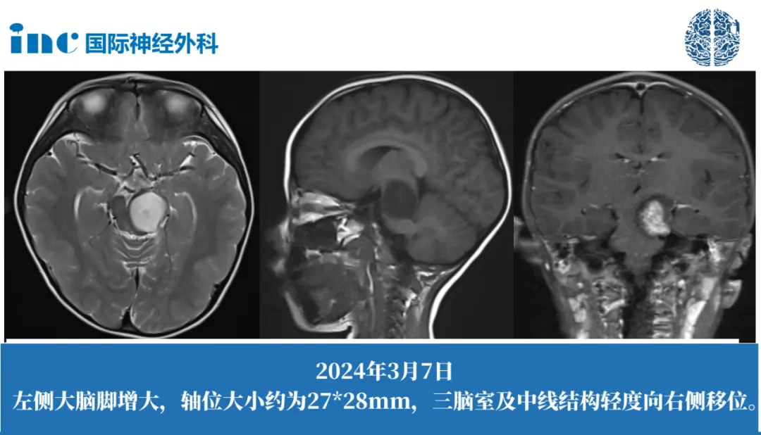 偶然查出脑干占位性病变巴教授能做手术吗？  　　切除率达到99%或100%