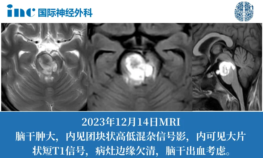 脑海绵状血管瘤科普：这个位置的脑出血竟会瘫痪、失语，但是却有治愈机会！