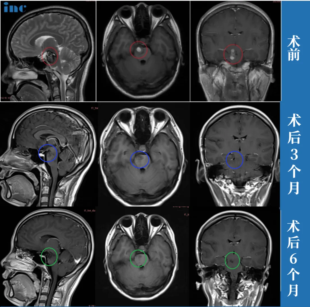 脑海绵状血管瘤产后出血昏迷案例图片