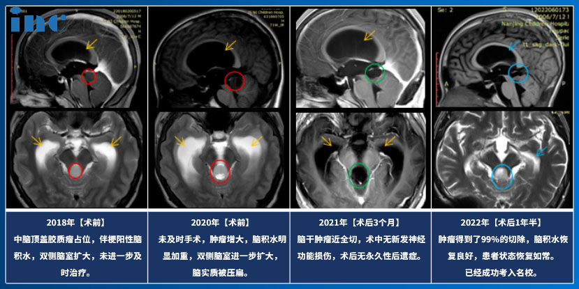 14岁男孩——脑干-中脑顶盖毛细胞星形细胞瘤影像图片