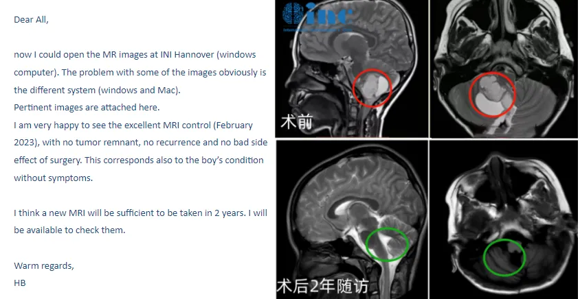 6岁男孩——小脑-脑干毛细胞星形细胞瘤影像图片