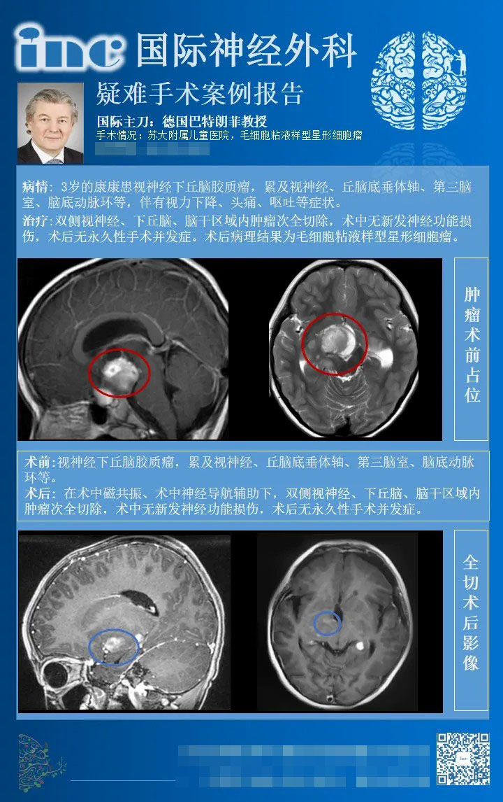 毛细胞粘液样型星形细胞瘤手术案例图片