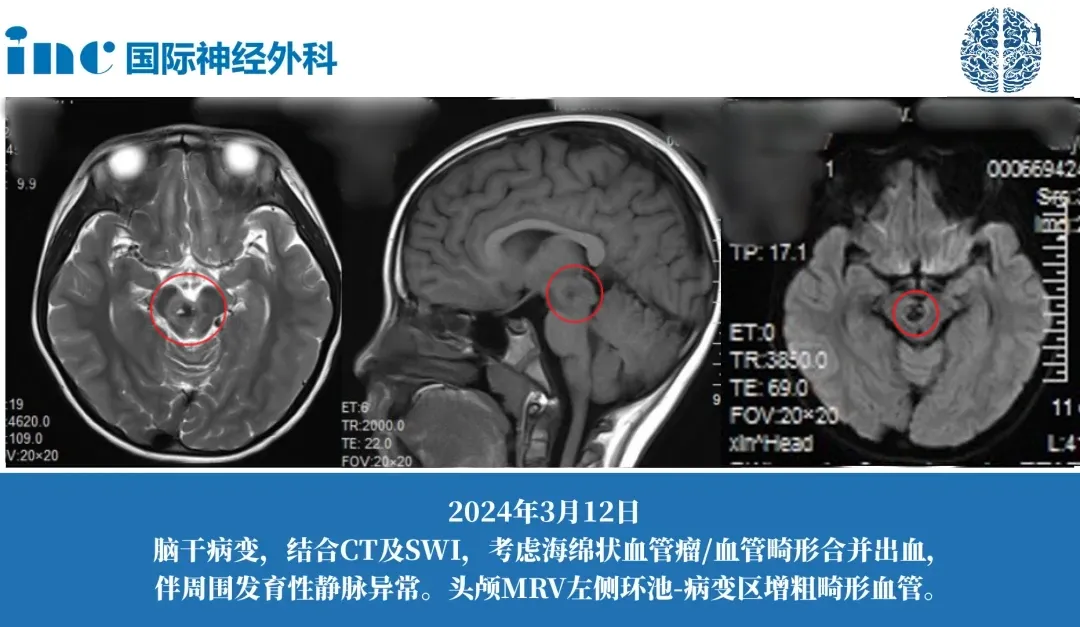 巴特朗菲教授手术案例图片