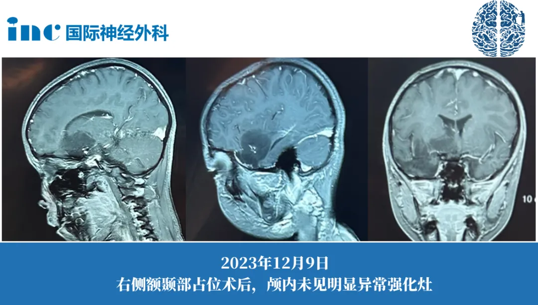 10岁男孩-DNET伴癫痫影像图片