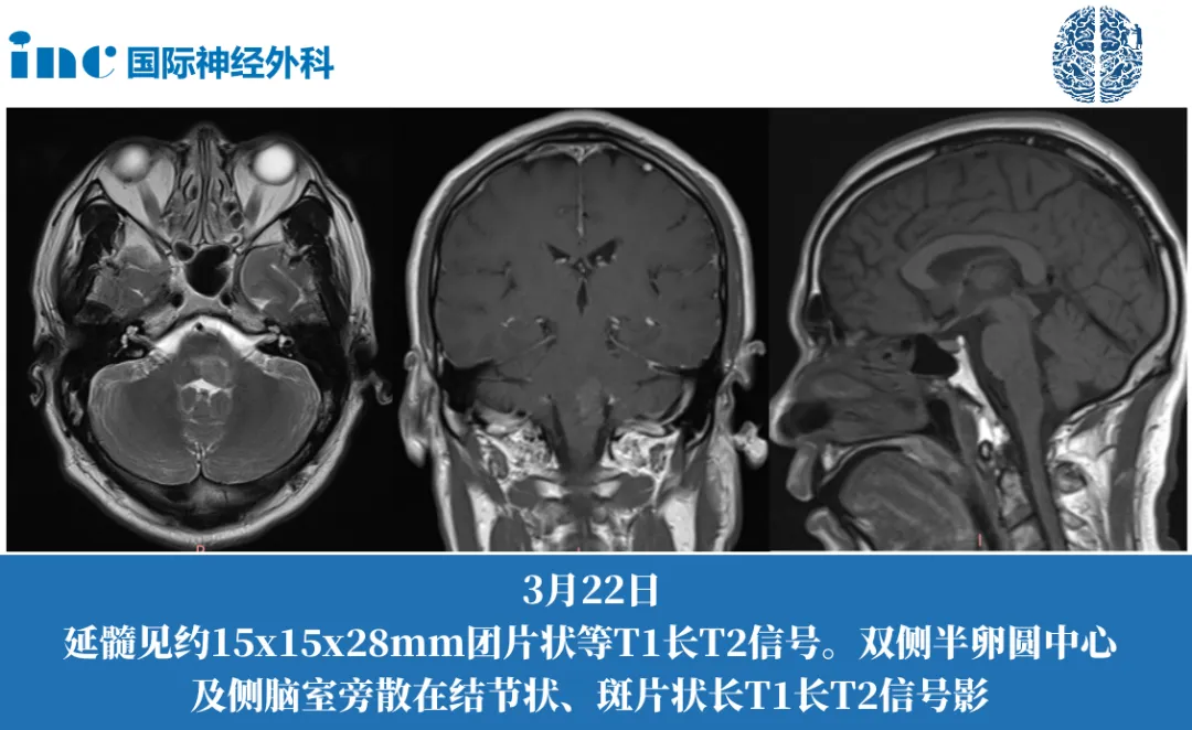 51岁男性-延髓占位性病变图片