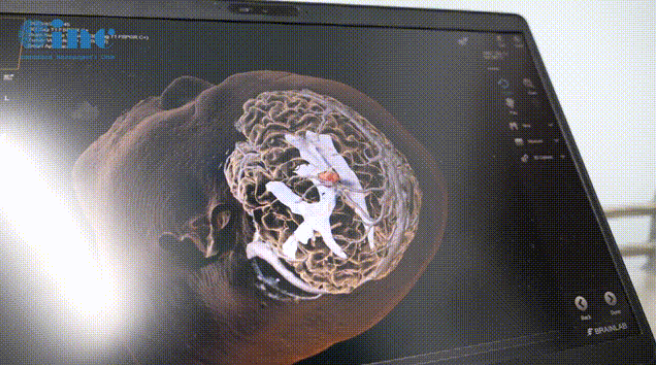 巴教授利用术中神经功能导航精准定位肿瘤