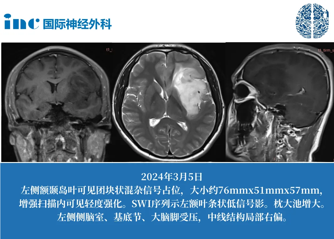 岛叶位置的脑肿瘤会导致癫痫、记忆力减退？INC国际教授如何攻克？