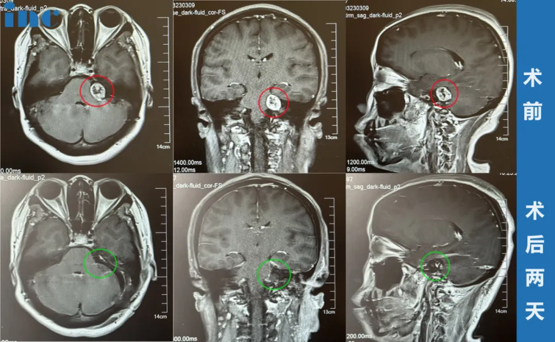 46岁女士——左侧听神经瘤图片