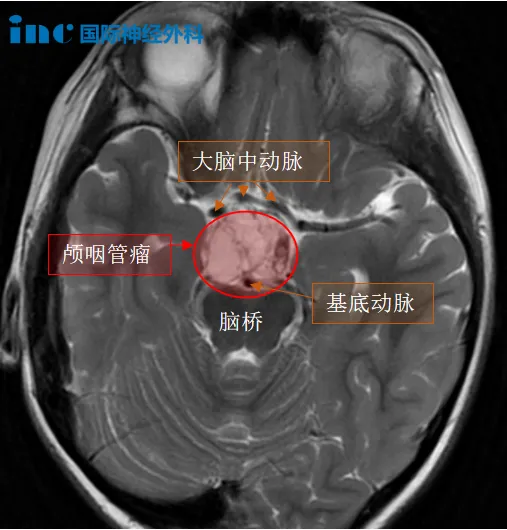 7岁男孩颅咽管瘤影像图片