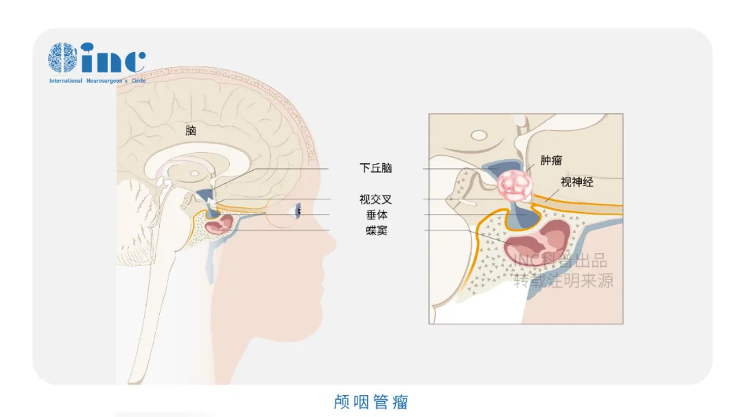 颅咽管瘤图片