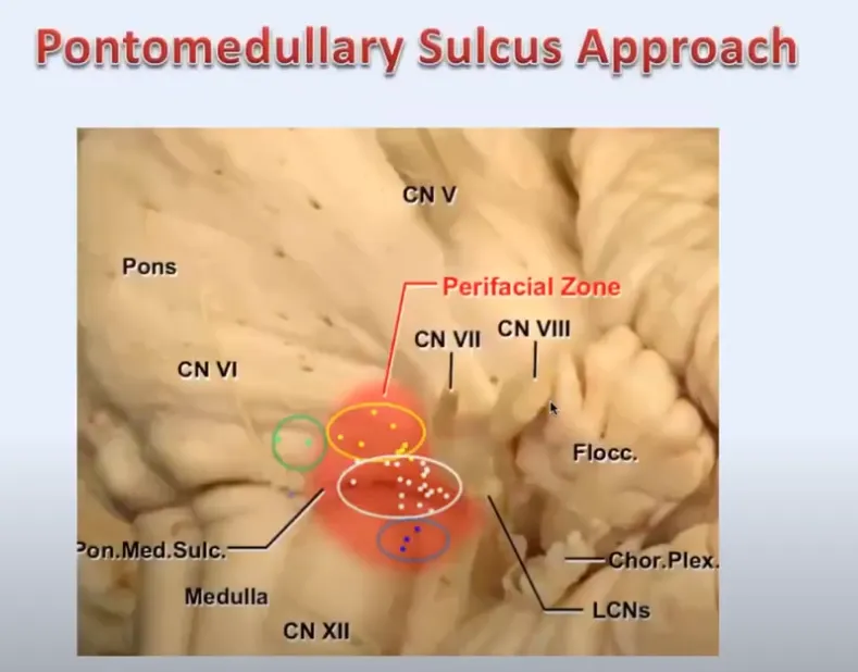巴教授脑干海绵状血管瘤学术演讲中关于该手术入路解读