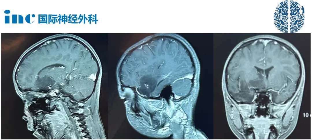 胚胎发育不良性神经上皮肿瘤DNET