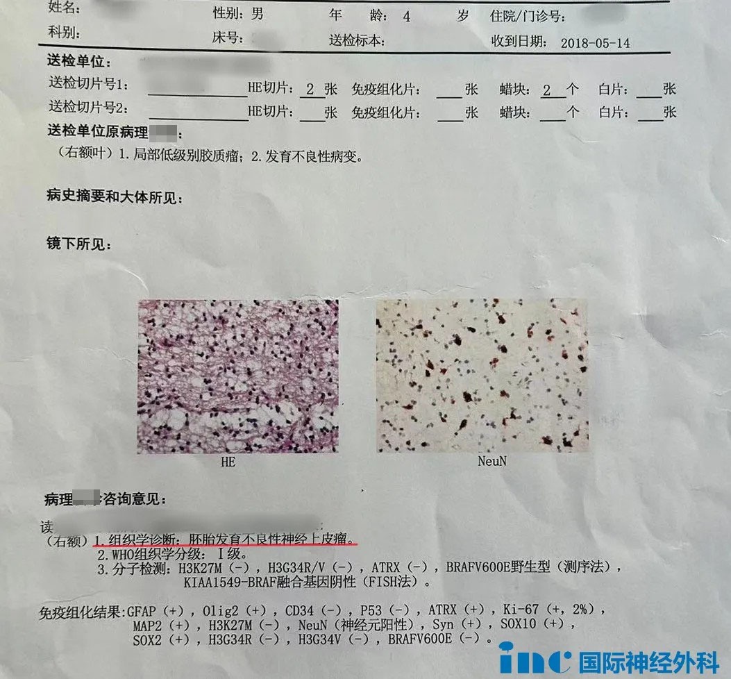 胚胎发育不良性神经上皮肿瘤DNET检查