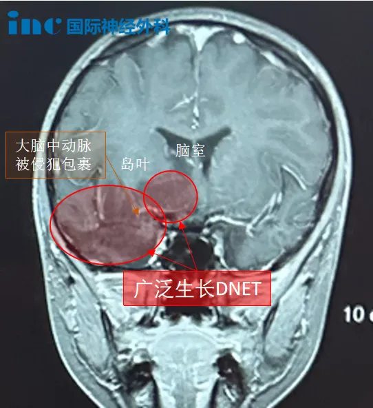 胚胎发育不良性神经上皮肿瘤DNET