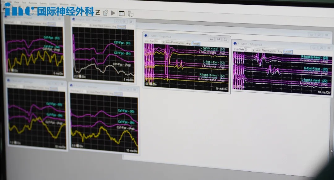 胚胎发育不良性神经上皮肿瘤DNET——电生理监测