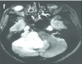 f-42岁男性。FLAIR轴向磁共振成像显示右侧大肿瘤，伽马刀治疗后小脑明显受损