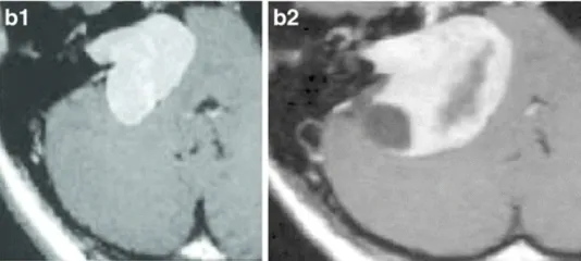 b-22岁女性。b-1增强后轴向MRI显示右侧中等大小的肿瘤(伽马刀治疗前)。b-2增强后轴向MRI显示肿瘤进一步生长压迫脑干和小脑(伽马刀治疗后3年)。肿瘤缺乏中央强化，可见小囊肿形成。