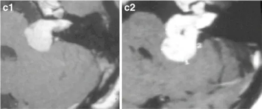 c-28岁女性。c-1增强后轴向MRI显示左侧中等大小的肿瘤，均匀强化(伽马刀治疗前)。c-2增强后的轴位MRI显示肌内和肌外部分的生长(伽马刀治疗后2年)。