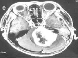 e-36岁女性。增强后轴向磁共振成像显示左侧巨大肿瘤，在不适当的三次伽马刀治疗后明显压迫脑干。