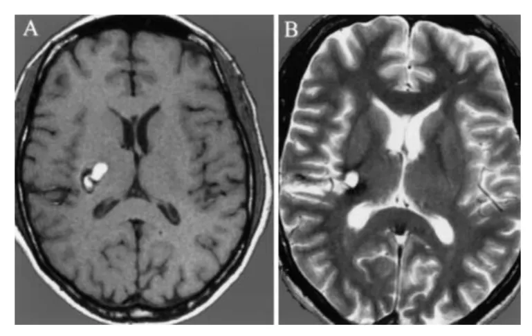 巴教授神经导航引导下切除基底神经节海绵状瘤。a，术前t1加权MR图像显示病变向内囊附近延伸。b，海绵状血管瘤瘤完全切除后的术后t2加权MRI