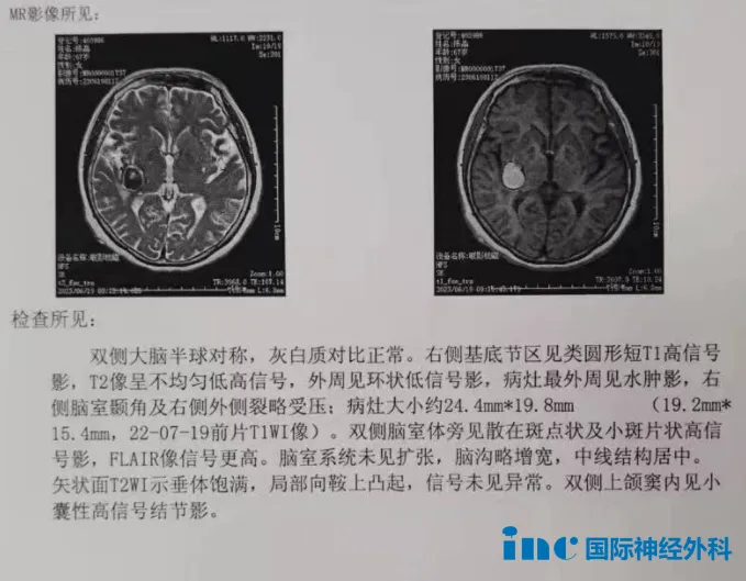 68岁女性--罹患基底节海绵状血管瘤