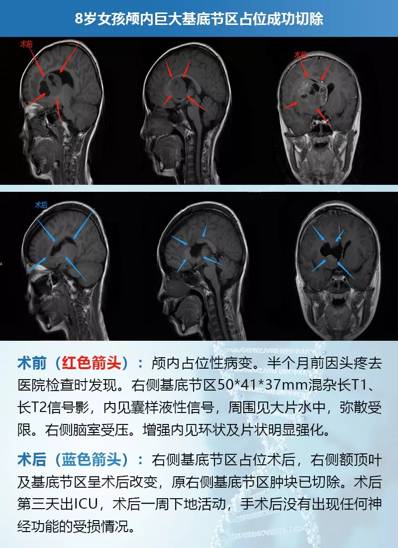 8岁女孩5cm较大基底节区肿瘤成功切除记|INC案例交流