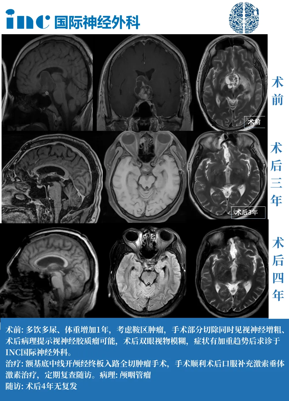 35岁男性——成功全切，术后4年无复发