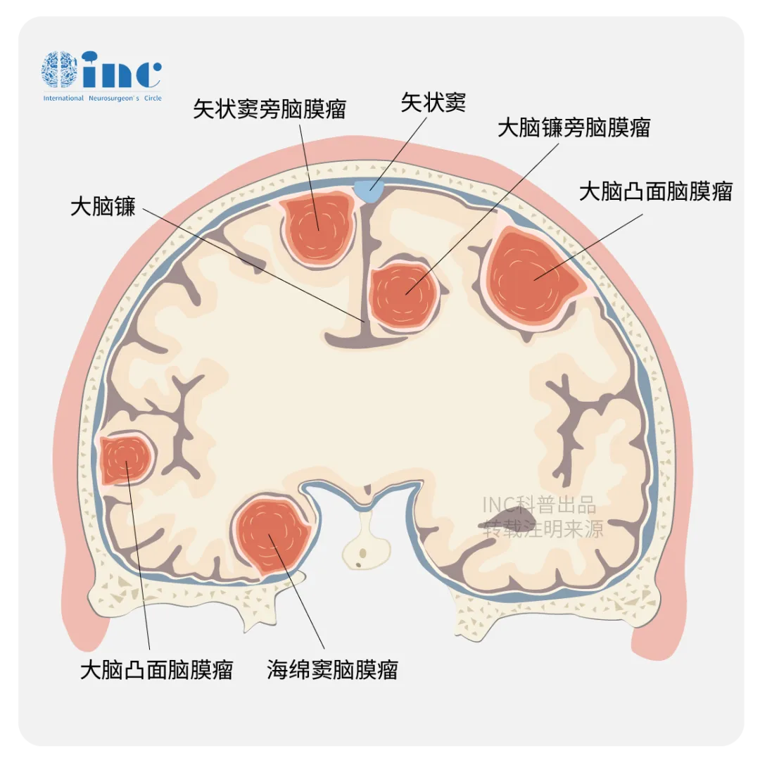 脑膜瘤图片