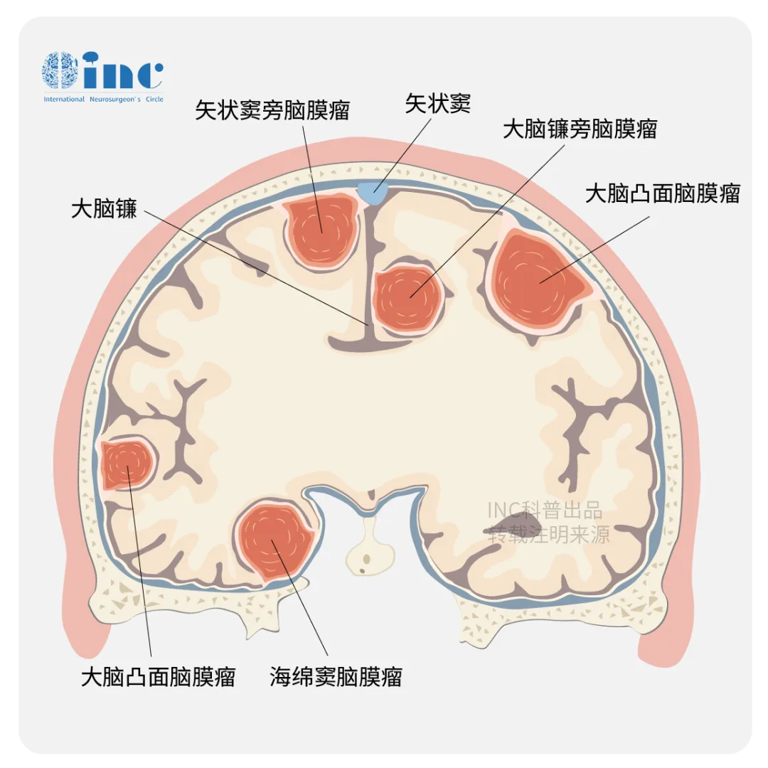 为什么脑膜瘤明明“全切”了，