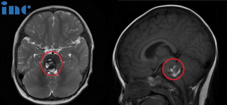 术前：脑桥占位。双眼斜视、畏光，面瘫，频发不自主扭头动作，走路稍有不稳。头颅MR(红色区域)显示:脑桥血肿，可见16 x 22 x 21mm肿块，第四脑室受压变窄。