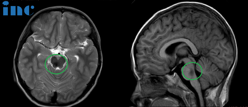 术后：头颅MR(蓝色区域)显示小脑半球及脑干形态正常，中线结构居中，原脑桥内团块状信号消失。