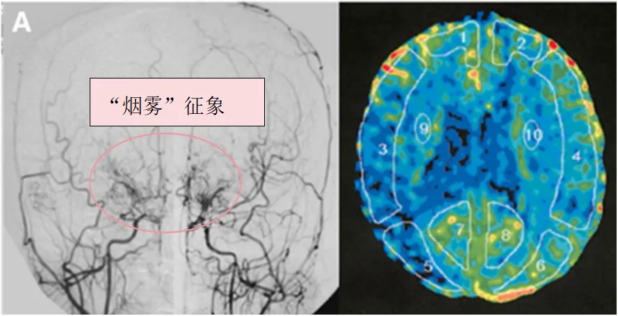图1：A,术前血管造影(双侧颈总动脉正位图)显示双侧颈内动脉末端有“烟雾血管狭窄征象”，双侧大脑中动脉(MCA)狭窄(左)。术前Xe-CT显示双侧MCA区域脑血流减少(右:15.9，左:22.8 ml/100 g/min)(右)。