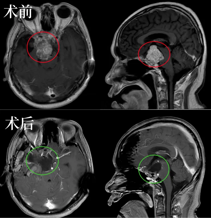 48岁男性反复复发高难度鞍区脊索瘤