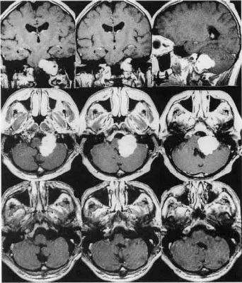 术前MRI显示左侧颈静脉孔巨大占位，颅内外延伸，术后确诊神经鞘瘤，术后2年复查MRI显示肿瘤完全切除且无复发